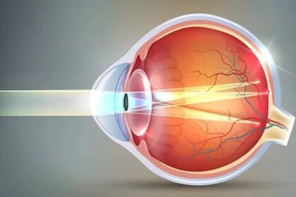 астигматизм